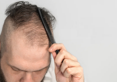 پکیج درمانی ریزش مو
